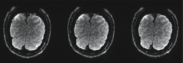 0.75 x 0.75 x 0.75mm resolution Single-shot gradient echo EPI, TE=31