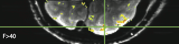 1 x 1 x 1mm resolution Single-shot gradient echo EPI, TE=30